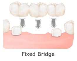 Dental Bridges Tooth Replacement Holladay Utah